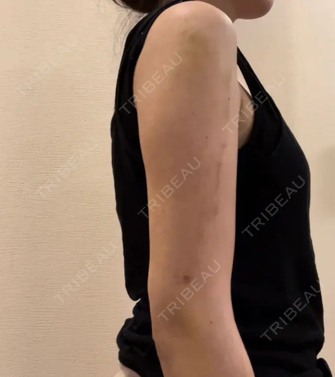 脂肪吸引（二の腕） Mods Clinic（モッズクリニック） 名古屋院 DAY 11 メイン用