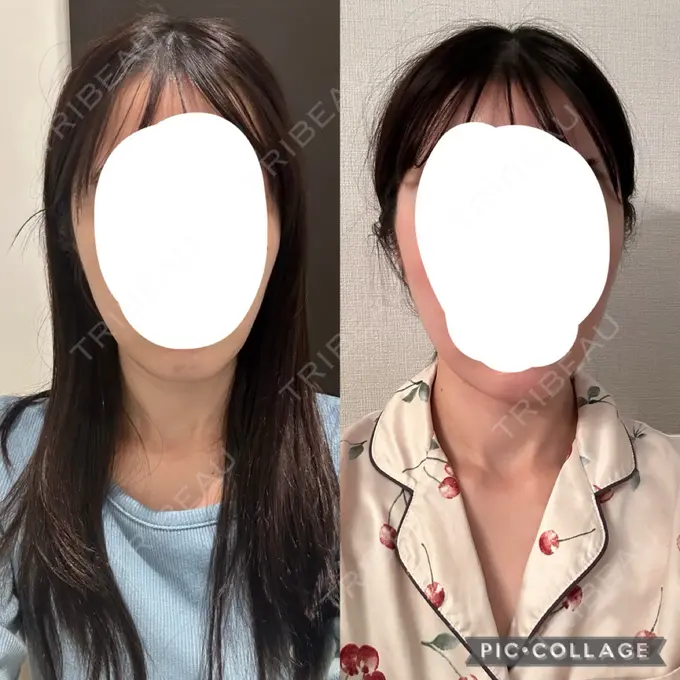 糸リフト / 脂肪吸引（顔） / ボトックス（エラ・小顔） RIVER CLINIC（リバークリニック） DAY 29 メイン用