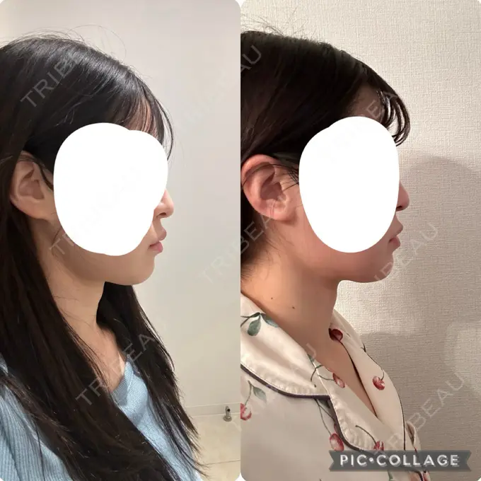 糸リフト / 脂肪吸引（顔） / ボトックス（エラ・小顔） RIVER CLINIC（リバークリニック） DAY 29 メイン用