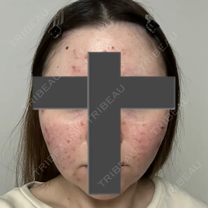 ニードルRF（ポテンツァなど） 東京美容外科 池袋院 AFTER メイン用