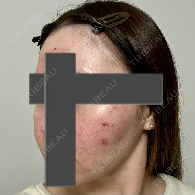 ニードルRF（ポテンツァなど） 東京美容外科 池袋院 DAY 7 メイン用