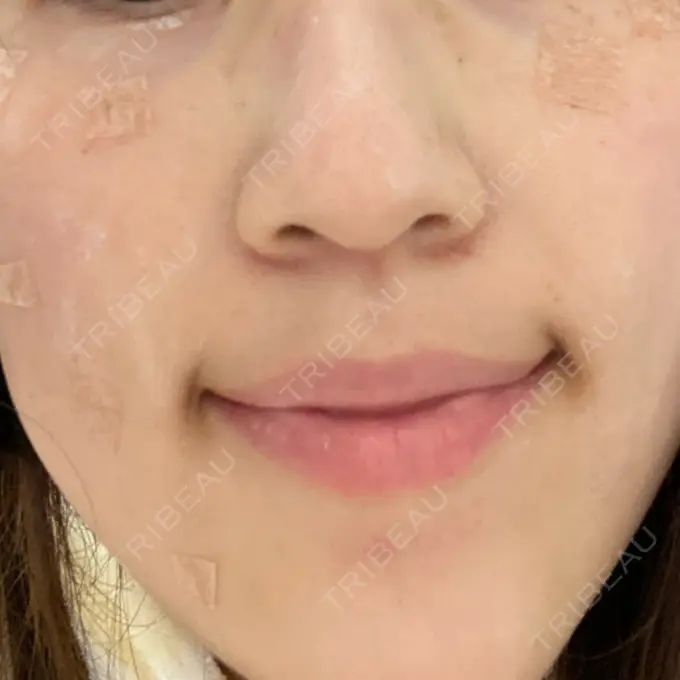 シミ取りレーザー Mavie Beauty Clinic （マヴィービューティークリニック） DAY 7 メイン用