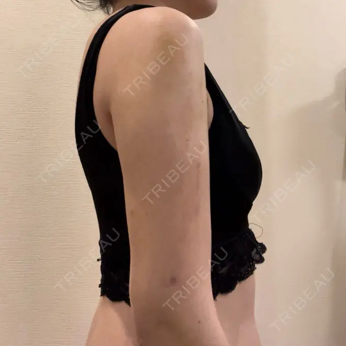 脂肪吸引（二の腕） Mods Clinic（モッズクリニック） 名古屋院 DAY 13 メイン用