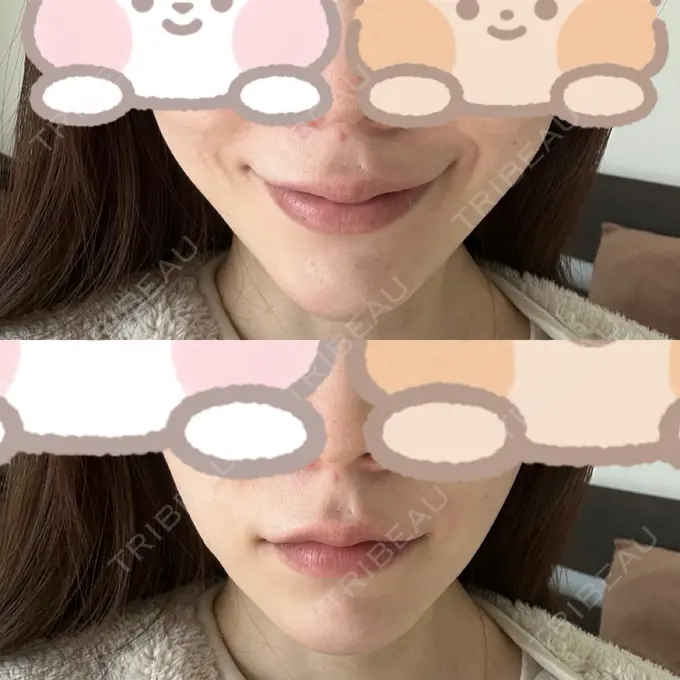 糸リフト / バッカルファット除去 RIVER CLINIC（リバークリニック） AFTER メイン用