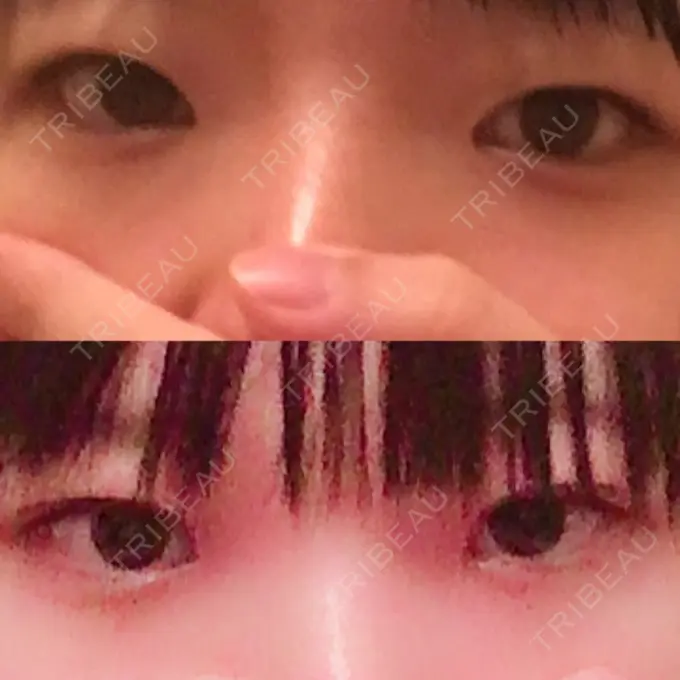 二重切開 / 上まぶたの脂肪取り 聖心美容クリニック 横浜院 DAY 20 メイン用