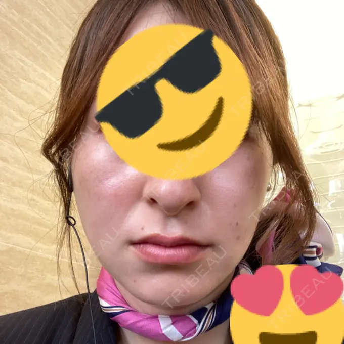 イオン導入 / 光治療（フォトフェイシャルなど） 美容皮膚科エルムクリニック 神戸院 AFTER メイン用