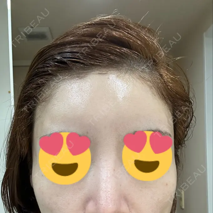 ヒアルロン酸注入（頬） シェリークリニック 新宿本院 DAY 8 メイン用