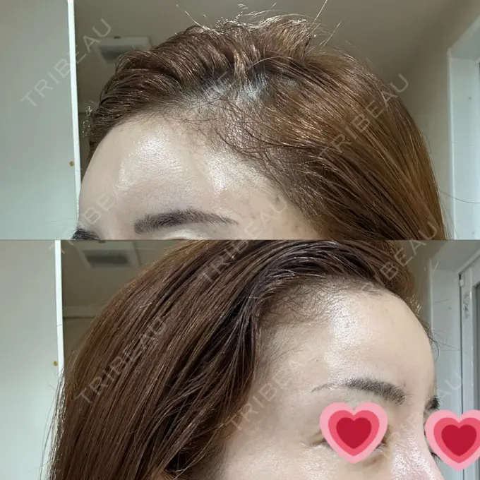 ヒアルロン酸注入（頬） シェリークリニック 新宿本院 DAY 8 メイン用