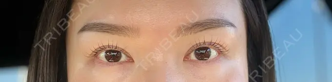 二重埋没 東京シンデレラ美容外科 大宮院 AFTER メイン用