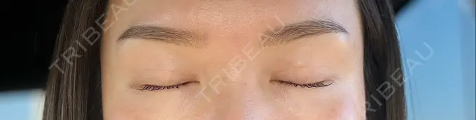 二重埋没 東京シンデレラ美容外科 大宮院 DAY 92 メイン用