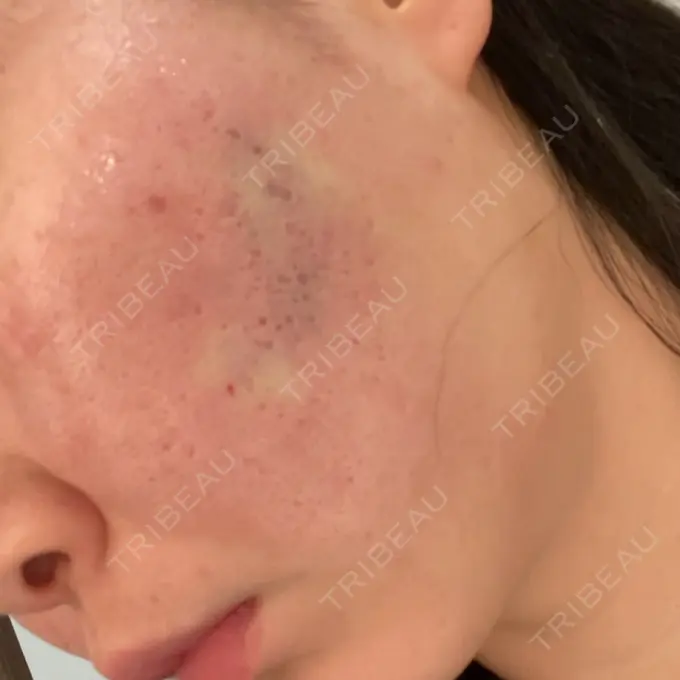 ヒアルロン酸注入（頬） / その他（肌） ゆきスキンクリニック 東池袋 DAY 0 メイン用