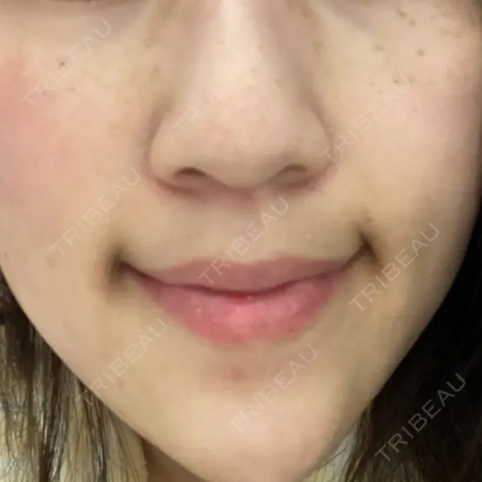 シミ取りレーザー Mavie Beauty Clinic （マヴィービューティークリニック） DAY 9 メイン用