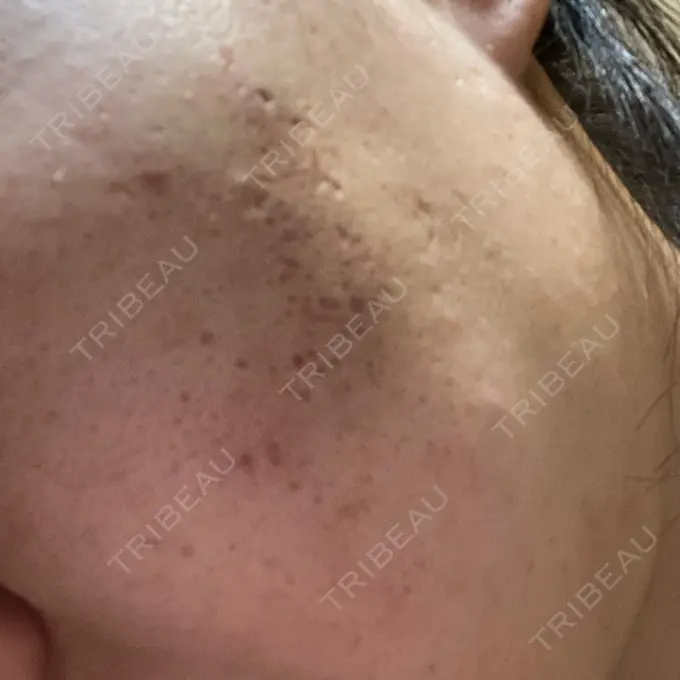 ヒアルロン酸注入（頬） / その他（肌） ゆきスキンクリニック 東池袋 DAY 1 メイン用