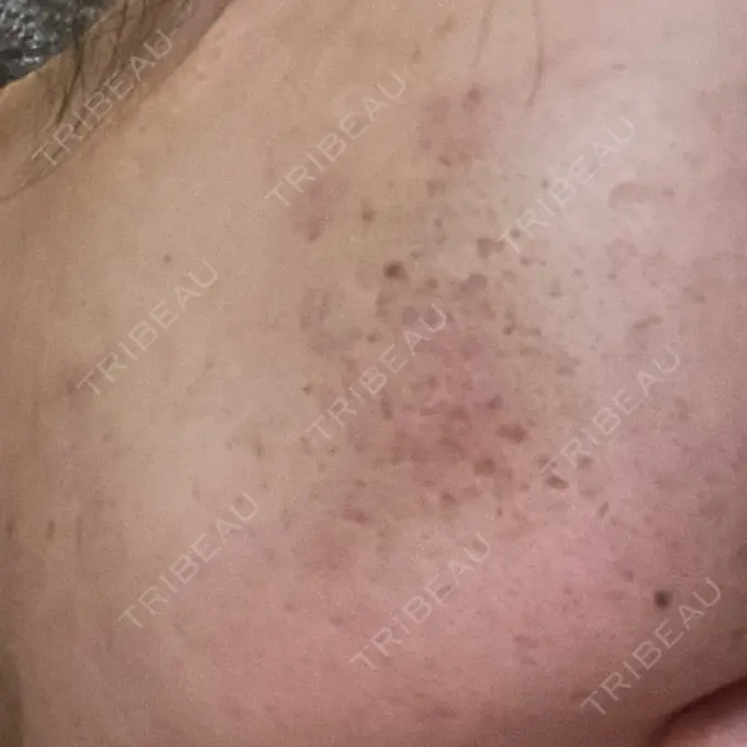 ヒアルロン酸注入（頬） / その他（肌） ゆきスキンクリニック 東池袋 DAY 1 メイン用