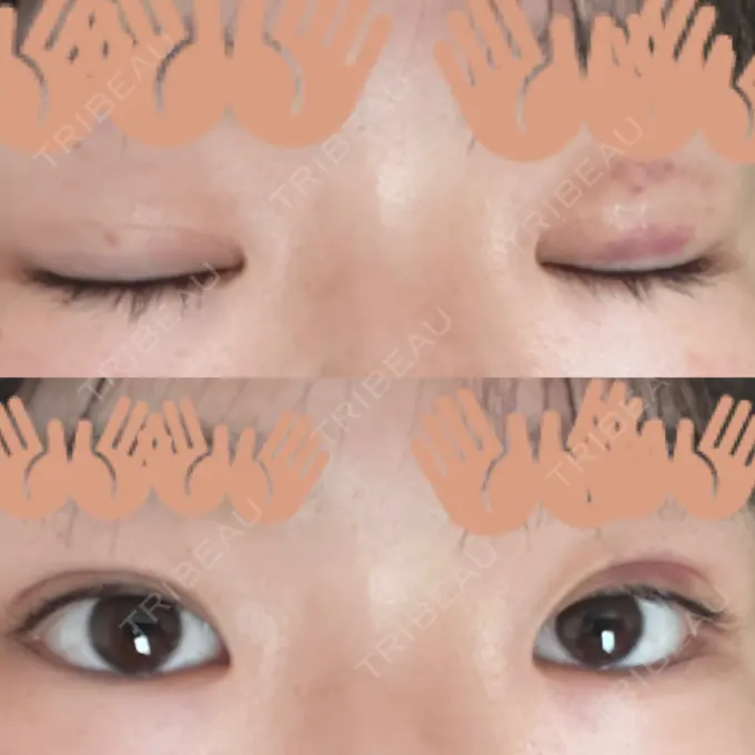 二重埋没 / ヒアルロン酸注入（涙袋） 藤・ナチュレ美容クリニック 銀座院 DAY 13 メイン用