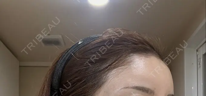 ヒアルロン酸注入（頬） シェリークリニック 新宿本院 DAY 28 メイン用