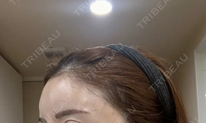 ヒアルロン酸注入（頬） シェリークリニック 新宿本院 DAY 28 メイン用