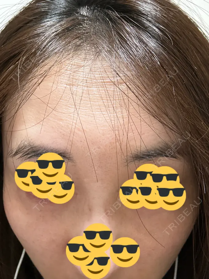 人中短縮 / ボトックス（あご） / ボトックス（目尻） / ボトックス（額） / その他（鼻） 湘南美容クリニック 岐阜院 AFTER メイン用