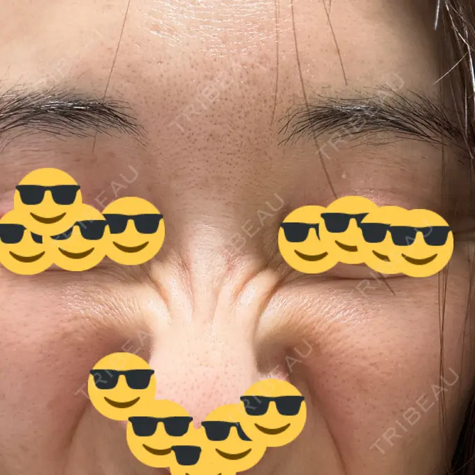 人中短縮 / ボトックス（あご） / ボトックス（目尻） / ボトックス（額） / その他（鼻） 湘南美容クリニック 岐阜院 DAY 7 メイン用