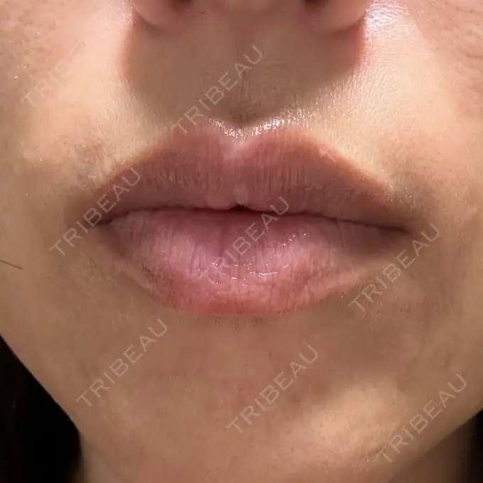 人中短縮 / ボトックス（あご） / ボトックス（目尻） / ボトックス（額） / その他（鼻） 湘南美容クリニック 岐阜院 DAY 7 メイン用