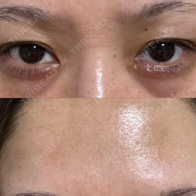 ヒアルロン酸注入（涙袋） / ボトックス（額） 渋谷美容外科クリニック 渋谷院 DAY 12 メイン用