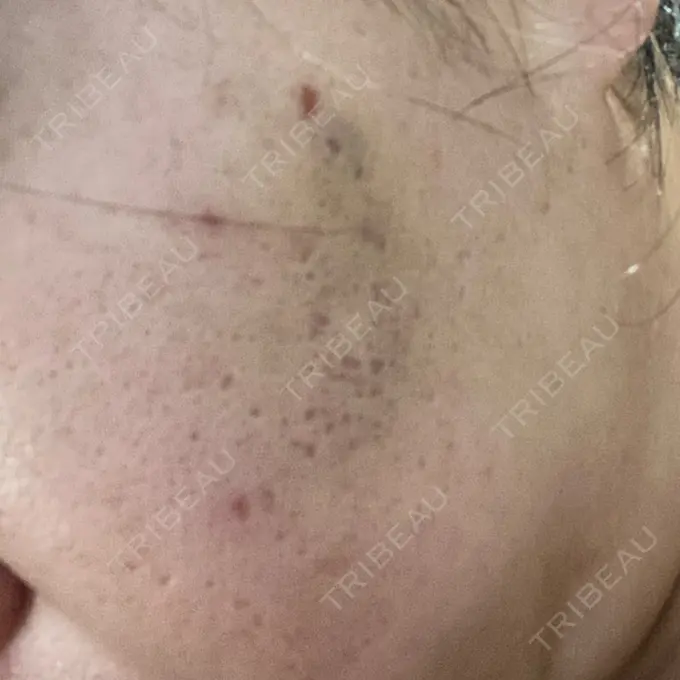 ヒアルロン酸注入（頬） / その他（肌） ゆきスキンクリニック 東池袋 DAY 2 メイン用