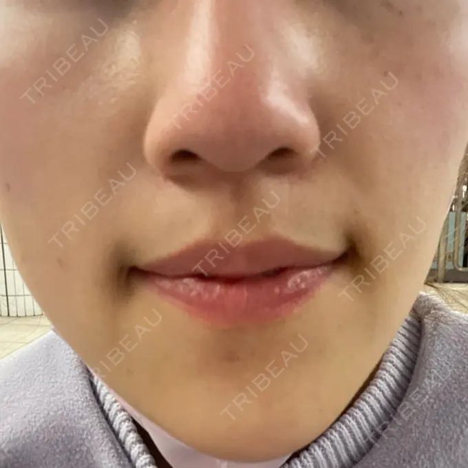 シミ取りレーザー Mavie Beauty Clinic （マヴィービューティークリニック） DAY 10 メイン用