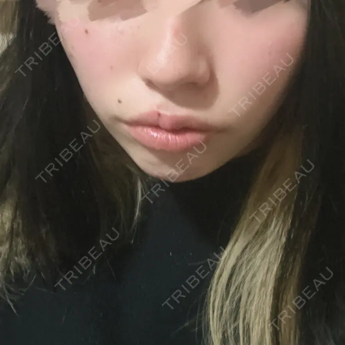 ヒアルロン酸注入（唇） / ボトックス（口角） ルラ美容クリニック 名古屋栄院 / ルラスキンクリニック 名古屋栄院 AFTER メイン用