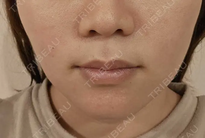 その他（口元） 東京銀座A CLINIC デンタル DAY 7 メイン用