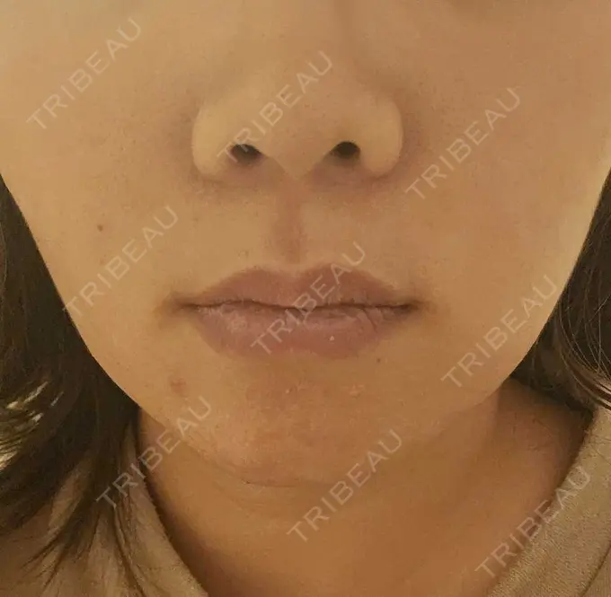 その他（口元） 東京銀座A CLINIC デンタル DAY 8 メイン用