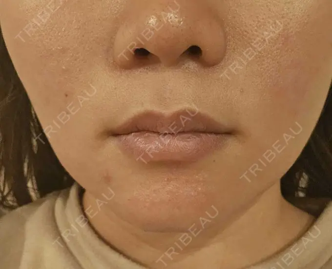 その他（口元） 東京銀座A CLINIC デンタル DAY 9 メイン用