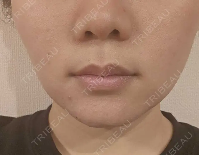 その他（口元） 東京銀座A CLINIC デンタル DAY 10 メイン用