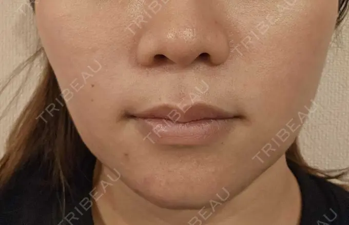 その他（口元） 東京銀座A CLINIC デンタル DAY 11 メイン用