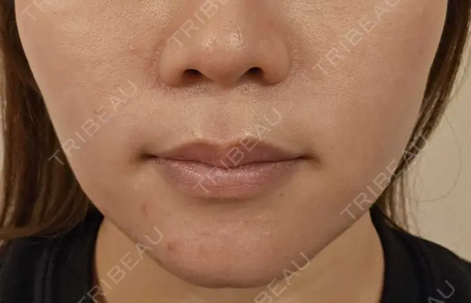 その他（口元） 東京銀座A CLINIC デンタル DAY 13 メイン用