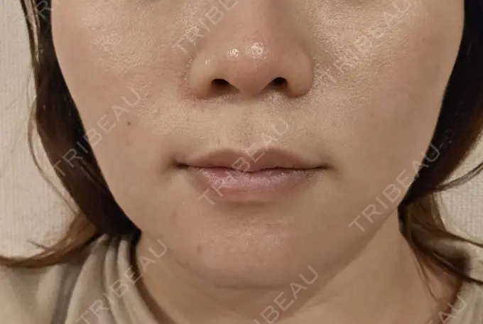 その他（口元） 東京銀座A CLINIC デンタル DAY 14 メイン用