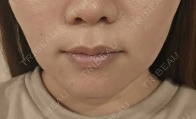 その他（口元） 東京銀座A CLINIC デンタル DAY 21 メイン用