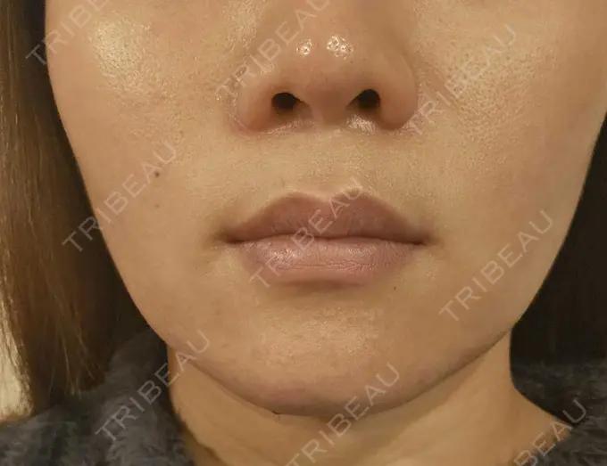 その他（口元） 東京銀座A CLINIC デンタル AFTER メイン用