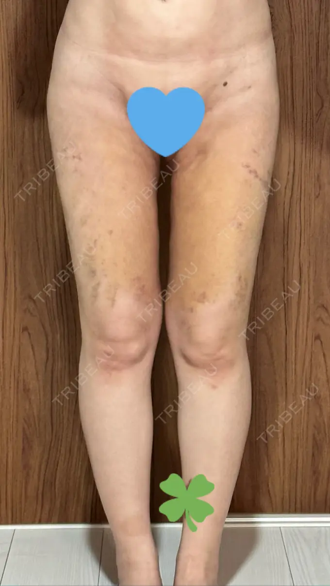 脂肪吸引（顔） / 脂肪吸引（脚） / 脂肪吸引（お尻） Mods Clinic（モッズクリニック） 福岡院 DAY 14 メイン用