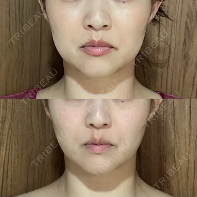 脂肪吸引（顔） / 脂肪吸引（脚） / 脂肪吸引（お尻） Mods Clinic（モッズクリニック） 福岡院 DAY 14 メイン用