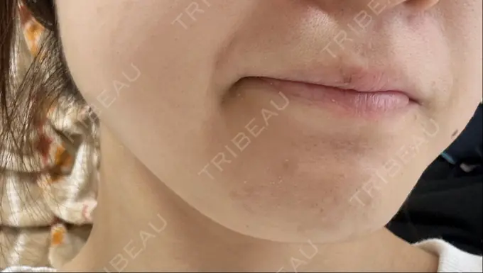 ボトックス（エラ・小顔） / 脂肪溶解注射（顔） CLINIC W DAY 12 メイン用