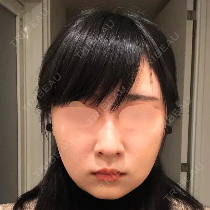 バッカルファット除去 / 脂肪吸引（顔） / ヒアルロン酸注入（鼻） / ボトックス（あご） / 水光注射（ハリ・美肌） / ボトックス（エラ・小顔） / ボトックス（口角） / 白玉点滴・注射 エートップ美容整形外科 DAY 7 メイン用