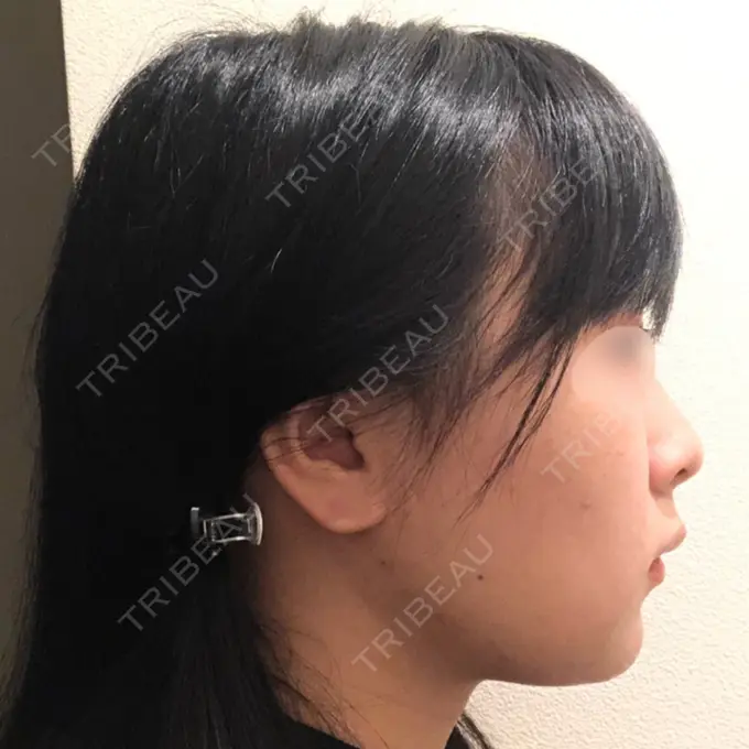 バッカルファット除去 / 脂肪吸引（顔） / ヒアルロン酸注入（鼻） / ボトックス（あご） / 水光注射（ハリ・美肌） / ボトックス（エラ・小顔） / ボトックス（口角） / 白玉点滴・注射 エートップ美容整形外科 DAY 7 メイン用