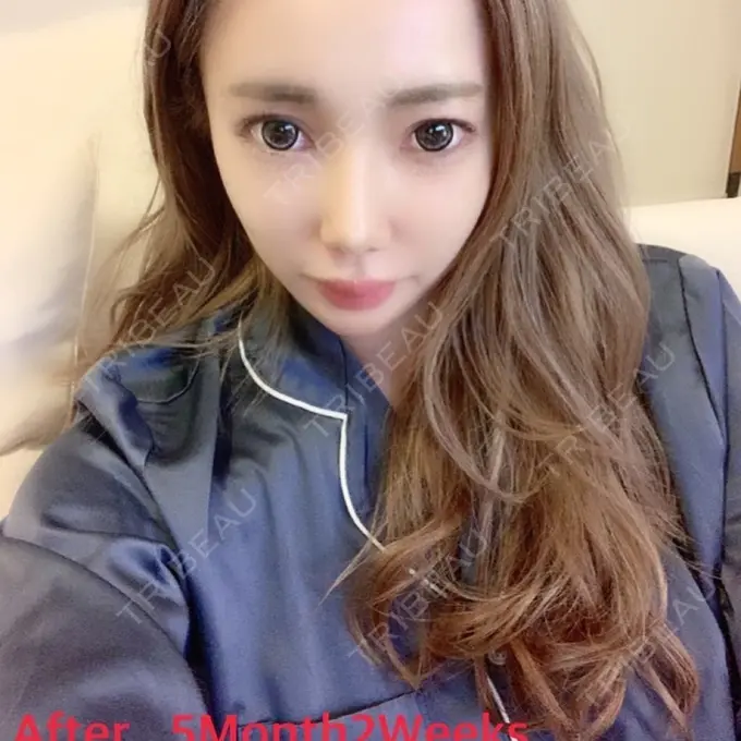 目頭切開 / 糸リフト / あごプロテーゼ / バッカルファット除去 / 目尻切開 / 軟骨移植 / 眉間プロテーゼ / ヒアルロン酸注入（涙袋） / その他（鼻） ミナ美容外科 DAY 164 メイン用