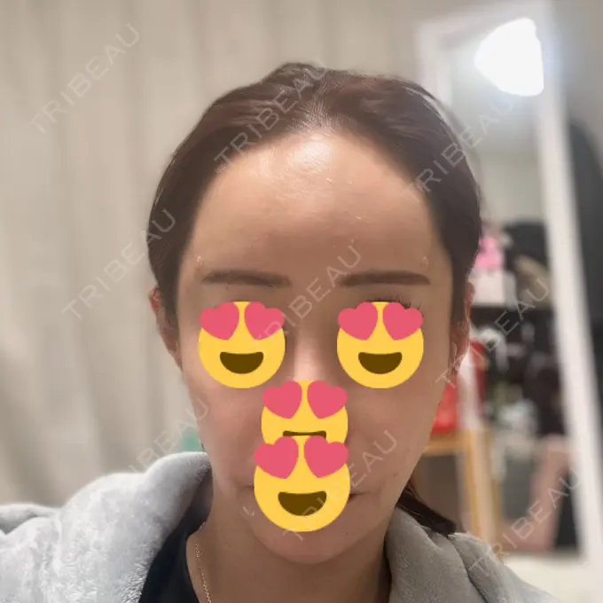 肌ヒアルロン酸注入（たるみ・シワ改善） / ヒアルロン酸注入（額） 豊洲内科・糖尿病 / 形成・美容外科クリニック DAY 1 メイン用