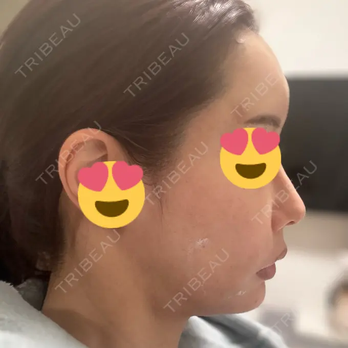 肌ヒアルロン酸注入（たるみ・シワ改善） / ヒアルロン酸注入（額） 豊洲内科・糖尿病 / 形成・美容外科クリニック DAY 1 メイン用