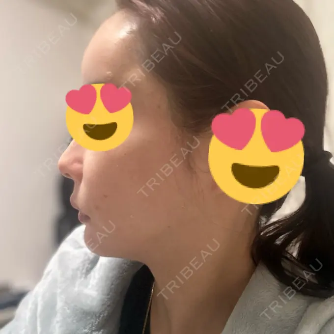 肌ヒアルロン酸注入（たるみ・シワ改善） / ヒアルロン酸注入（額） 豊洲内科・糖尿病 / 形成・美容外科クリニック DAY 1 メイン用