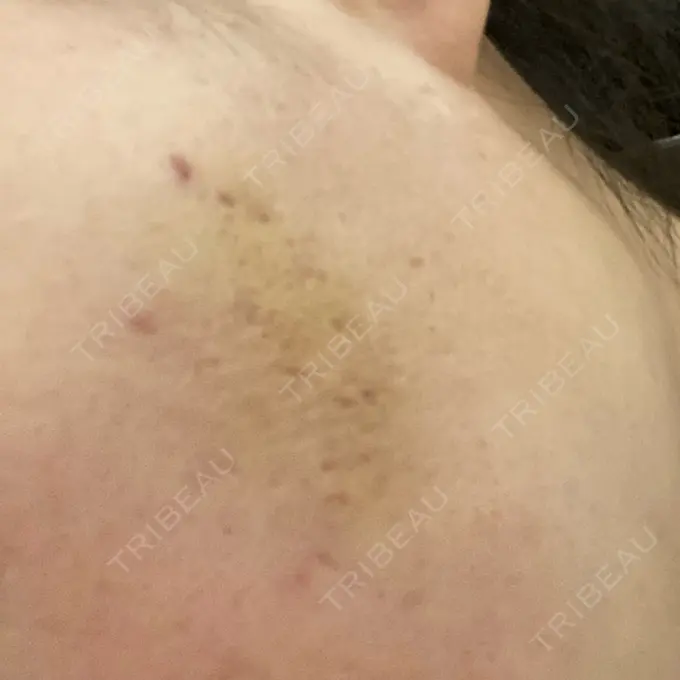 ヒアルロン酸注入（頬） / その他（肌） ゆきスキンクリニック 東池袋 DAY 5 メイン用