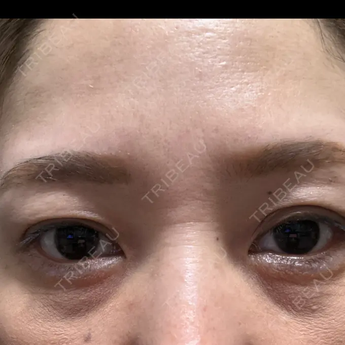 ヒアルロン酸注入（涙袋） / ボトックス（額） 渋谷美容外科クリニック 渋谷院 DAY 15 メイン用