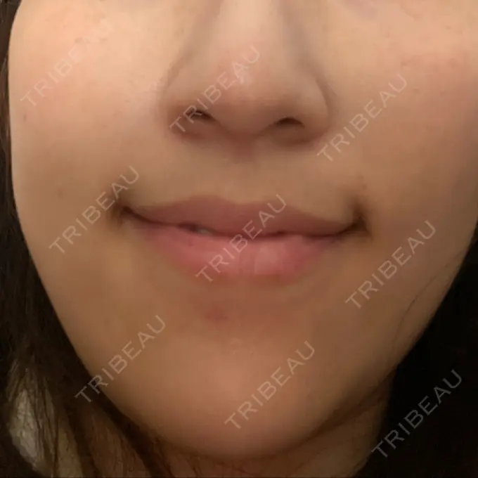 シミ取りレーザー Mavie Beauty Clinic （マヴィービューティークリニック） DAY 13 メイン用