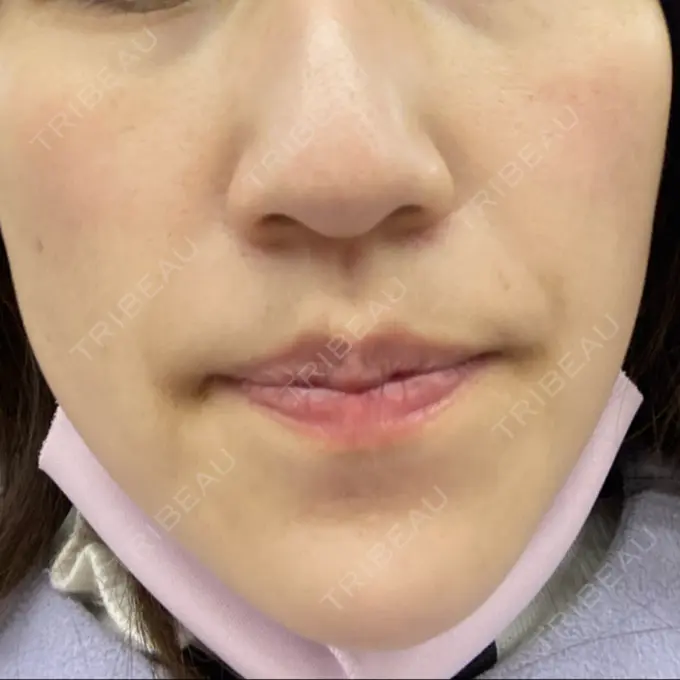 シミ取りレーザー Mavie Beauty Clinic （マヴィービューティークリニック） DAY 13 メイン用